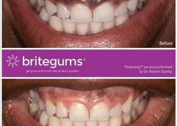 Gum Lightening Service