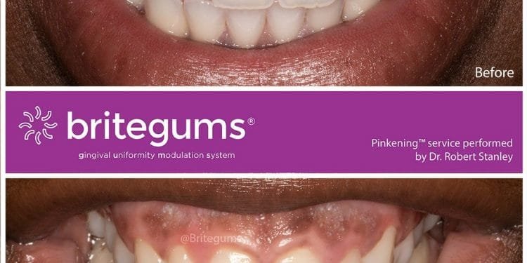 Gum Lightening Service