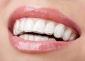 The Guide to Temporary Veneers and Dental Veneers