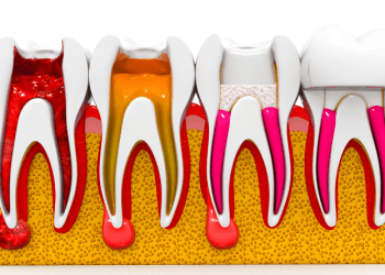 Root canal treatment