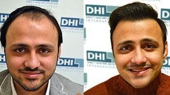 best hair transplant in Delhi