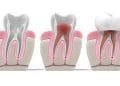 Root Canal Alternative & Root Canal Dangers | Holistic Root Canal Alternatives