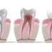 Root Canal Alternative & Root Canal Dangers | Holistic Root Canal Alternatives
