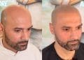 Scalp Micro Pigmentation Clinic