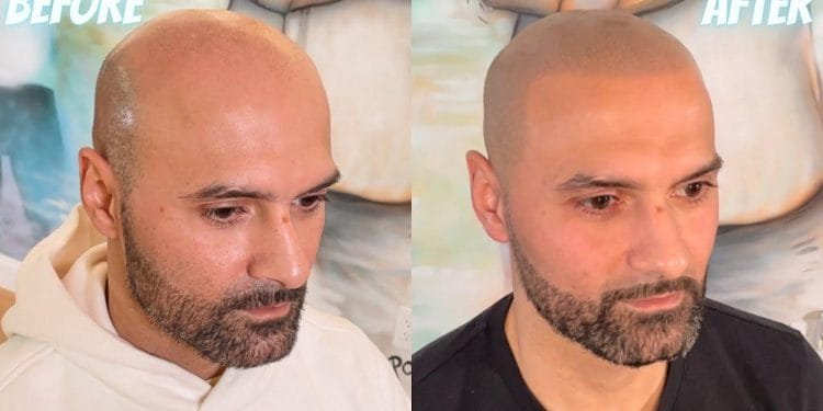 Scalp Micro Pigmentation Clinic