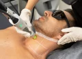 Laser Hair Removal