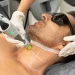 Laser Hair Removal