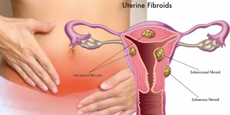 USA Fibroid Center In Atlanta